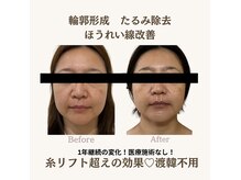 リス(LYS)の雰囲気（ダウンタイムなし！即日小顔効果◎エラボトサーマでたるみ改善♪）