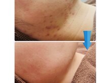 初回から効果実感◎上質なハーブとスピキュール（針）贅沢配合！