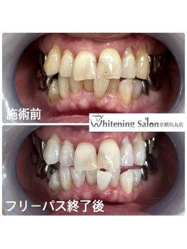 ホワイトニングサロン 京都烏丸店/ホワイトニング施術例