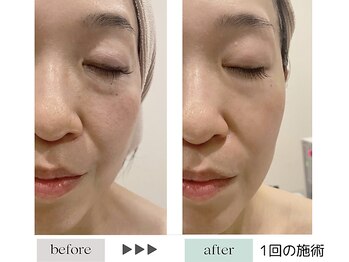 ジェニックサロン グランギンザ 水戸(GENIC SALON GRAND GINZA)/最新リフトアップ/水戸/たるみ