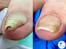 +1 Foot 本厚木【巻き爪/肥厚爪/魚の目/角質/副爪/整爪/フットケア】