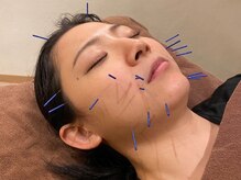 とんとん整骨院 鍼灸院 ときわ台/美容鍼