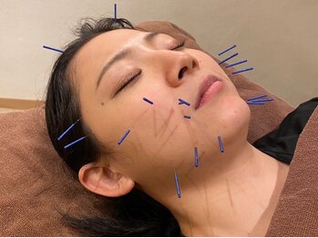 とんとん整骨院 鍼灸院 ときわ台/美容鍼