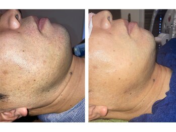 アネモネ ビューティーズ サロン(Anemone Beauty's salon)/ひげ脱毛 Before→After