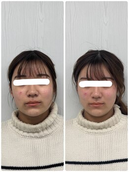 ラフテル鍼灸整骨院/卒業式/入学式に小顔整体/美容鍼