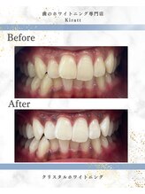 キラット 栃木店(Kiratt)/クリスタルセルフホワイトニング