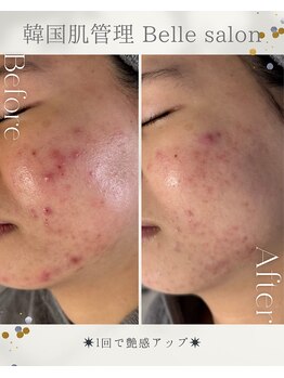ベルサロン(Belle salon)/ニキビ劇的改善