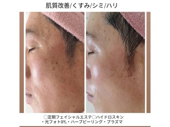 ユニクリア(Uni clear)/40代・50代 メンズフェイシャル