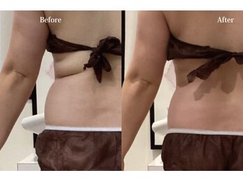 アネル 宮古島店(anel)/脂肪-溶解レモンボトル2回の結果