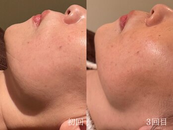 ウォーム(warm)/シワケア/小顔/マッサージ/小顔