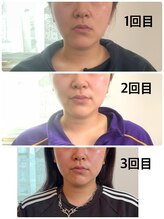 ラディユー(Radieux)/レモンボトルお客様施術例