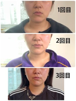ラディユー(Radieux)/レモンボトルお客様施術例