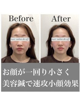 ハリサロンドオフ 心斎橋店(hari salon de off)/即効小顔効果