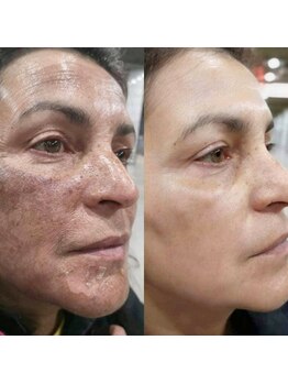 カシェットトーキョー(Cachette Tokyo)/2Bバイオトリートメント