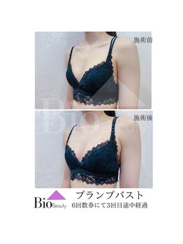 バイオビューティー 神戸本店(Bio Beauty)/プランプバスト　施術症例