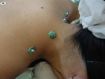 アタック鍼灸院(ATAC鍼灸院)/首・肩へのお灸