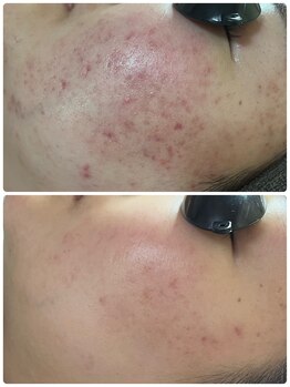 オウカ(OUKA)/ハーブピーリングでニキビケア