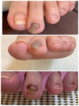 ルミエール(_Lumiere)/トラブルネイル