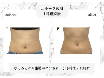 トキ(TOKI)/ユルーフ超音波痩身 お腹