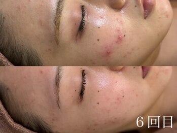 ホワイトアクア 北千住店(WHITE AQUA)/ハーブピーリング/6回