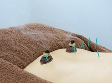 リケア 西新宿鍼灸院(reCare)の雰囲気（鍼とお灸をお好みに合わせて、どちらも使用します。）