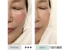 ジェニックサロン グランギンザ 水戸(GENIC SALON GRAND GINZA)/最新リフトアップ/水戸/たるみ