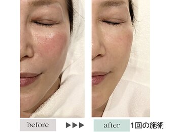 ジェニックサロン グランギンザ 水戸(GENIC SALON GRAND GINZA)/最新リフトアップ/水戸/たるみ