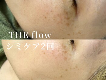 ザ フロウ(THE flow)/シミケア2回｜before/after