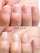 マリーロール 梅田店(Marie Laure)/自爪育成/深爪矯正/ネイルケア