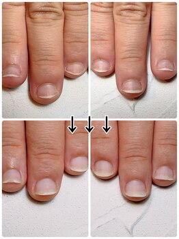 スマイルニコ(smile nico)/深爪矯正２週間