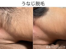 レーヴ/☆うなじ脱毛の効果☆