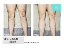 ティエル(TieLu)/足脱毛