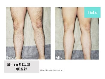 ティエル(TieLu)/足脱毛