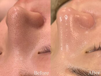 ビューティ ワンド ユズ(Beauty Wand YUZZ)/毛穴洗浄コース