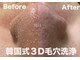 ベル(BELL)の写真/【諦めてた毛穴黒ずみに！】韓国式３D毛穴洗浄  17,600円→11,000円！導入キャンペーン価格エリア最安値！