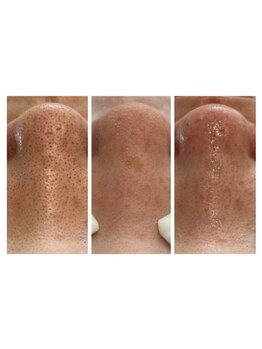 毛穴ケアをしたい