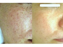 サロンドエステケイワイ(de KY)/フェイシャル☆濃いシミ改善