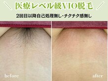 レッド(RED)/VIO脱毛