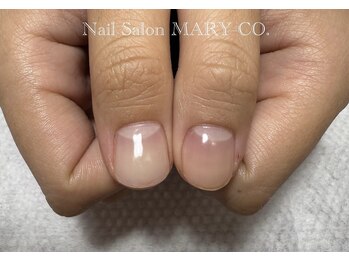 マリーシーオー(MARY-CO.)/【深爪矯正】モニター価格