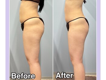 ベルミーランド 浜松天王/痩身Before→After