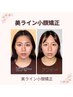 【1月限定】年始のむくみリセット！Ｖ字フェイスラインへ/美ライン小顔矯正