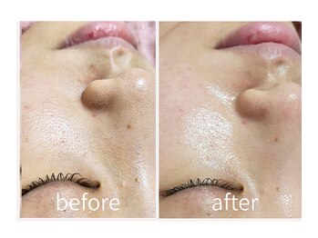 キレイラボ(Ki-Re-i LABO)/ハイドラ+ハーブピーリング