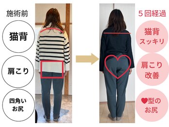 いろどり整体/【２０代女性】猫背、肩こり改善