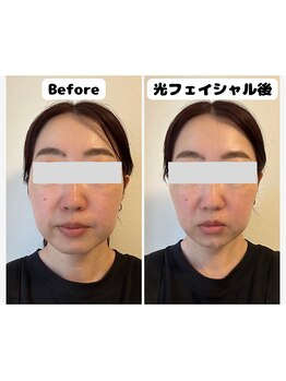 ウィローの写真/むくみ・口元やフェイスラインのたるみ改善へ◎即スッキリが実感できる人気の光フェイシャル◎ハリツヤ肌◎
