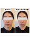 ウィローの写真/むくみ・口元やフェイスラインのたるみ改善へ◎即スッキリが実感できる人気の光フェイシャル◎ハリツヤ肌◎