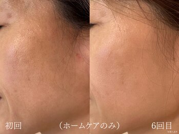 ウォーム(warm)/シワケア/小顔/マッサージ/小顔