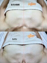 アシュリー 表参道(AsHLi)/ふっくらバストBBL