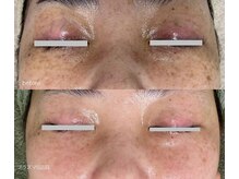サロンドジェシカ(salon de Jessica)/プラズマ シミしわ改善ケア