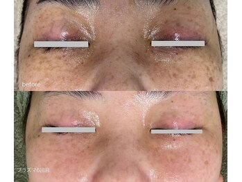 サロンドジェシカ(salon de Jessica)/プラズマ シミしわ改善ケア