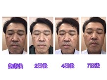 ラ スター 関内店(La star)/シミにアプローチ！シミケア